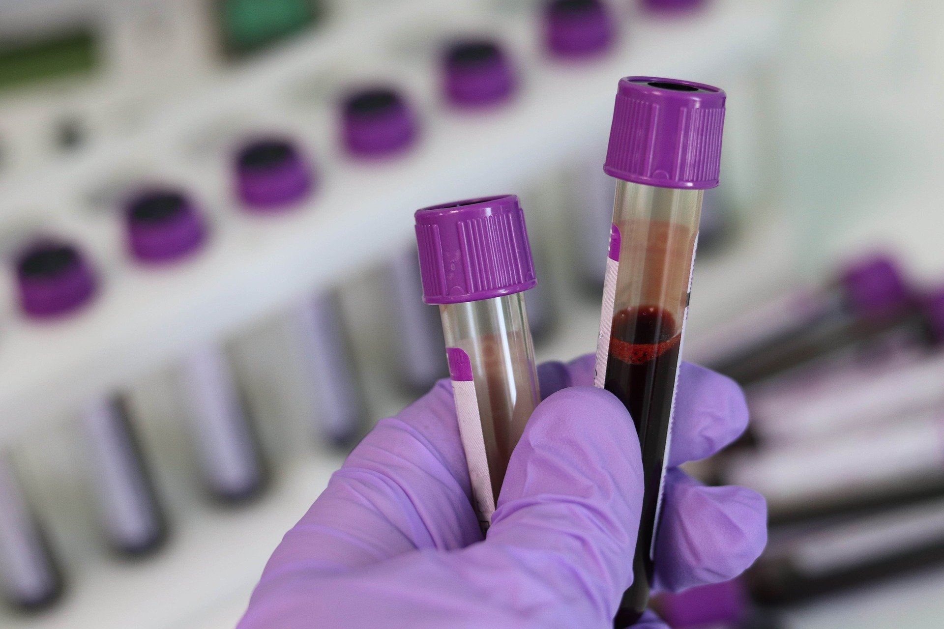 NEWS | Hereford Medical Group warns of shortages that mean that only urgent blood tests can be carried out