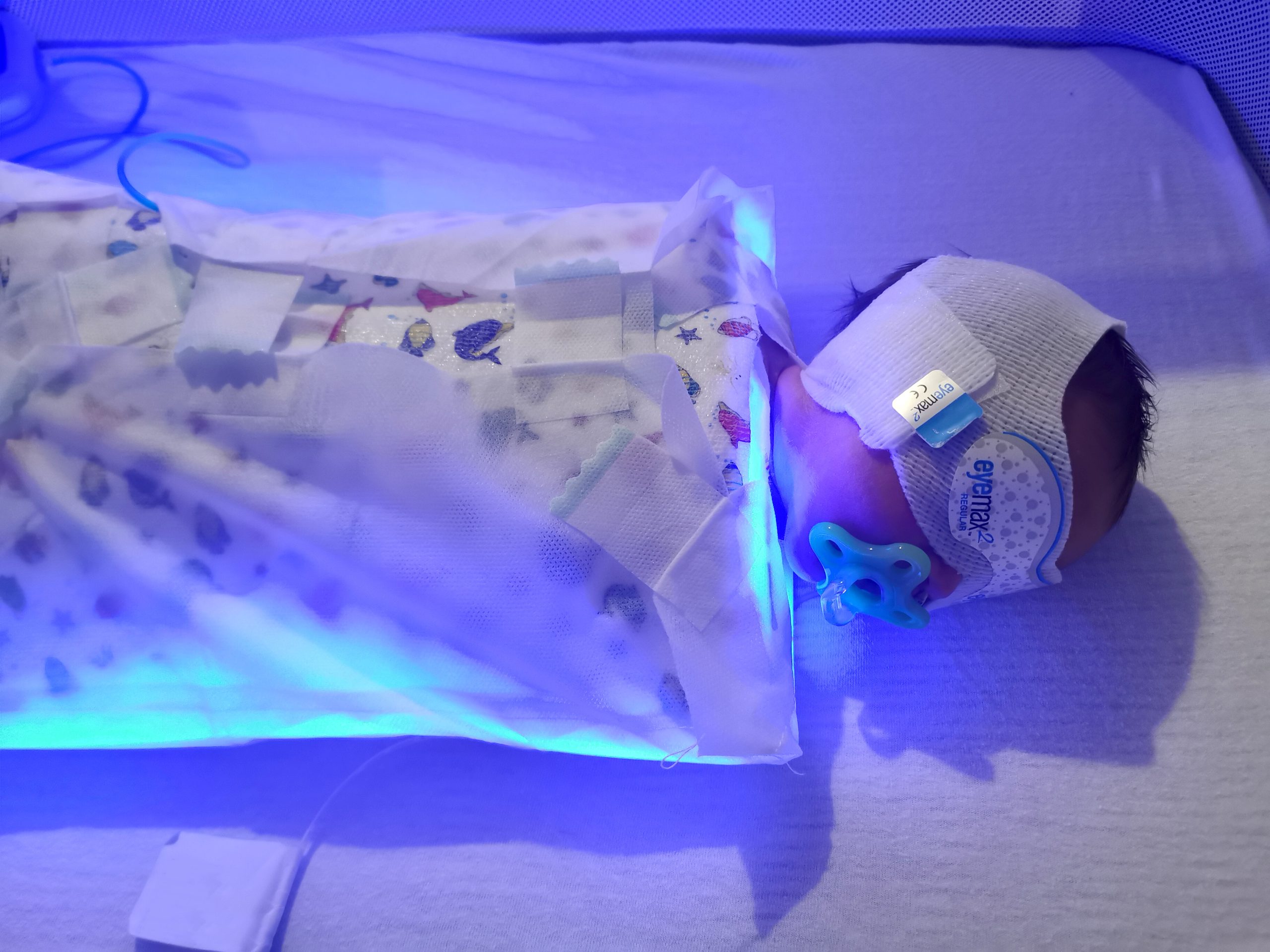 NEWS | A special cocoon which bathes babies with jaundice in special light is helping parents care for their new-borns at home